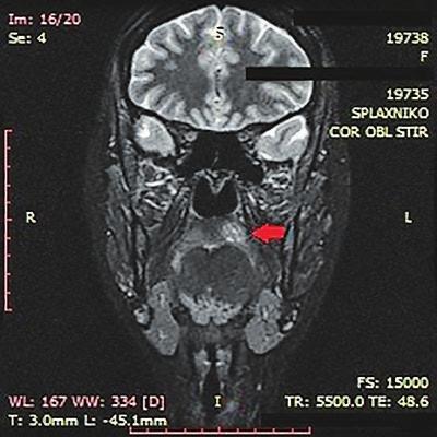 2 MRI σπλαχνικού κρανίου, με τα αντίστοιχα ευρήματα σε στεφανιαία τομή. γραμμένου, σχετικά μαλακής σύστασης και ανώδυνου στην ψηλάφηση.