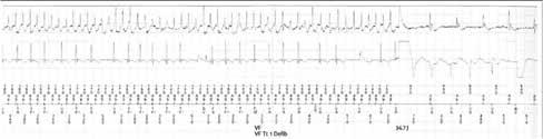 Σε ασθενή που έχει εμφυτευθεί stent στην καρωτίδα χρειάζεται διπλή αντιαιμοπεταλιακή αγωγή τον πρώτο μήνα. Γ.