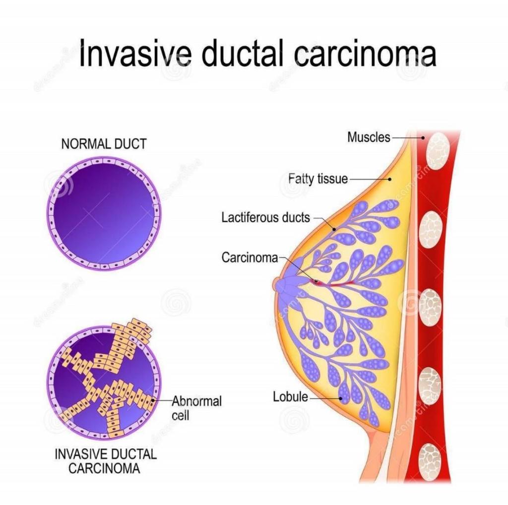 Διηθητικό πορογενές καρκίνωμα του μαστού (IDC): Πρόκειται για τον συνηθέστερο τύπο καρκίνου του μαστού στον οποίο η καρκινογένεση έχει ξεκινήσει από την εσωτερική μεμβράνη του γαλακτοφόρου πόρου που