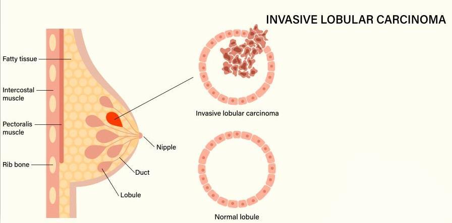 Διηθητικό λοβιακό καρκίνωμα του μαστού (ILC): Πρόκειται για τον δεύτερο συνηθέστερο τύπο καρκίνου του μαστού μετά τον IDC.