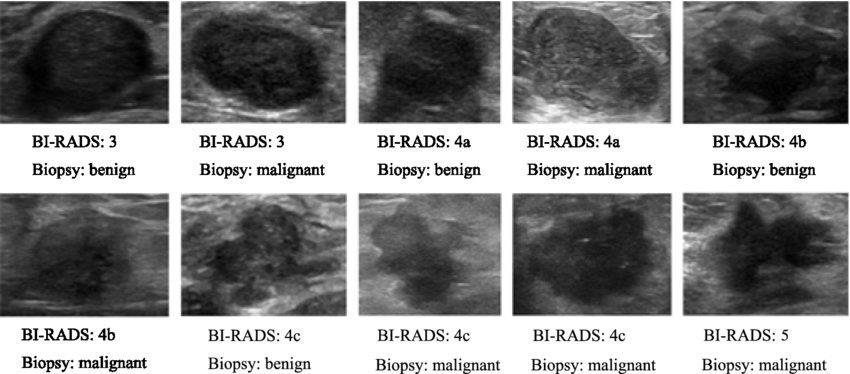 Εικόνα 1.7 Συγκεντρωτικά παραδείγματα κατηγοριοποίησης εικόνων με το σύστημα BI-RADS 1.