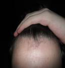 ΚΟΡΥΦΗ ΚΑΙ ΜΗ ΚΟΡΥΦΗ ΣΤΑ ΜΑΛΛΙΑ Tο χαρακτηριστικό «μη κορυφή στα μαλλιά» παρουσιάζεται σε μεγαλύτερο βαθμό, καθώς
