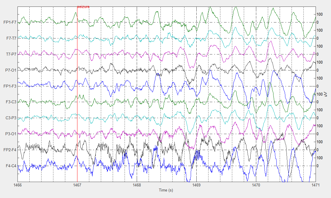 24 ΚΕΦΑΛΑΙΟ 1. ΕΙΣΑΓΩΓΗ Σχήμα 1.4: Παράδειγμα Επιληπτικής Κρίσης (έναρξη 1467s) Τα spindles είναι κύματα με συχνότητα 11-16Hz (συνήθως 12-14Hz) και διάρκεια 0.5-1.