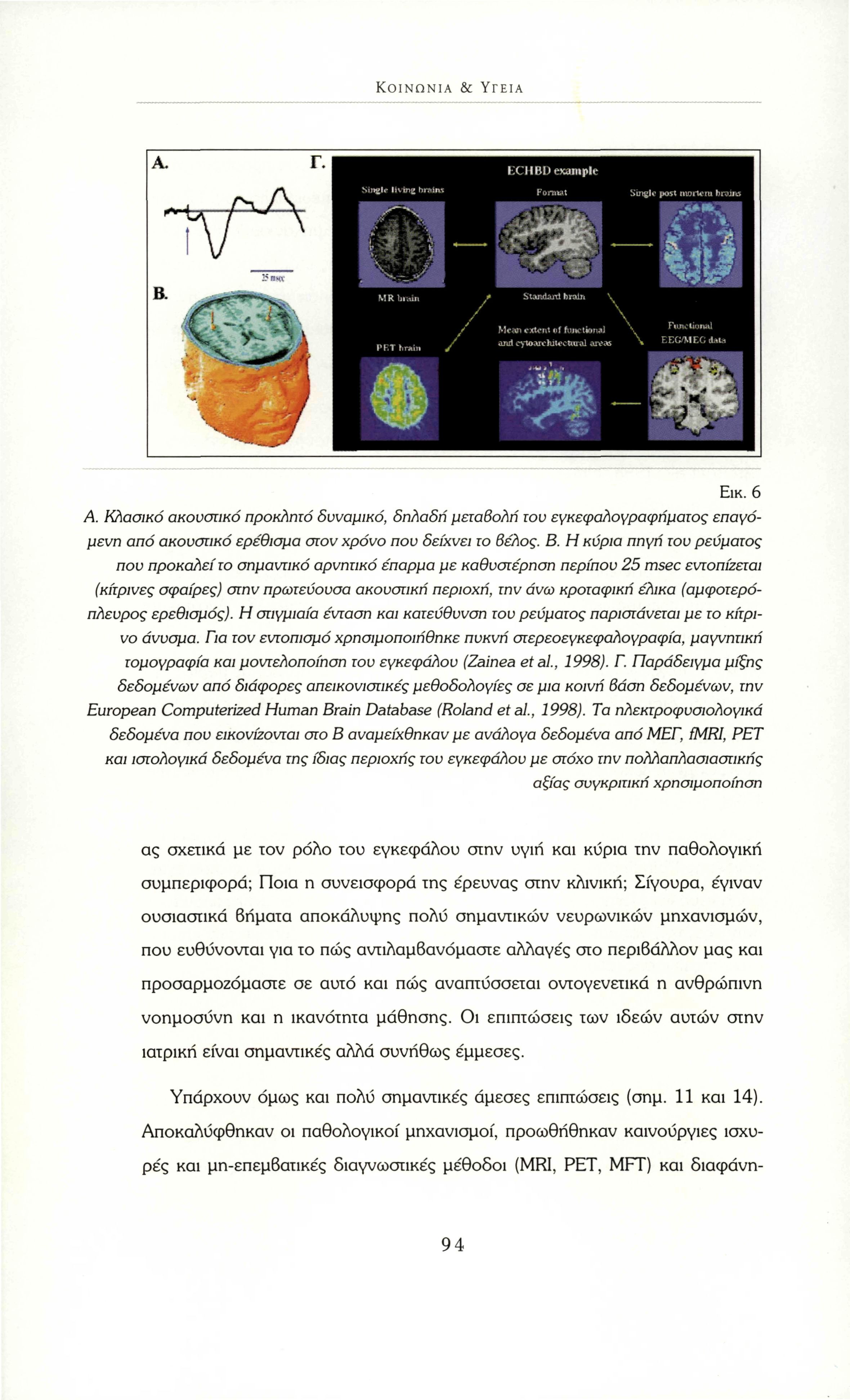 ΚΟΙΝΩΝΊΑ & ΥΓΕΊΑ Εικ. 6 Α. Κλασικό ακουστικό προκλητό δυναμικό, δηλαδή μεταβολή του εγκεφαλογραφήματος επαγόμενη από ακουστικό ερέθισμα στον χρόνο που δείχνει το βέλος. Β.