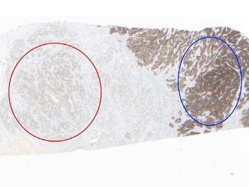 The HER2 IHC Gastric Module (Pre-pilot Results) Run 96 Selected Images Showing Optimal and Sub-optimal Immunostaining Fig 1.