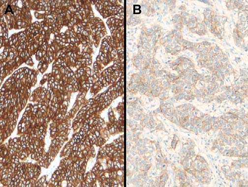 3+ membrane staining (blue oval) and an area of 2+ (red circle) membrane staining. Section stained using the Ventana 4B5 antibody. Fig 2.