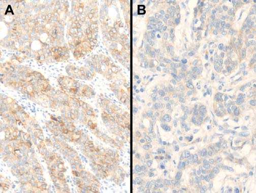 A) stained with Dako Herceptest and B) stained with the CCBE356 antibody clone. Fig 5.