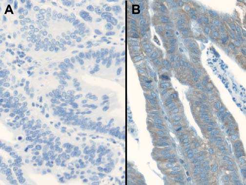 Both examples show moderate complete and basolateral membrane staining in > 1% of tumour cells. Fig 8.