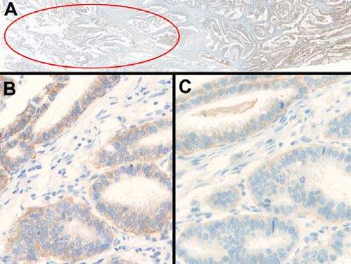 cytoplasmic staining making any membrane staining uninterpretable. Section stained using a homebrew method using the Dako polyclonal antibody. Fig 9.