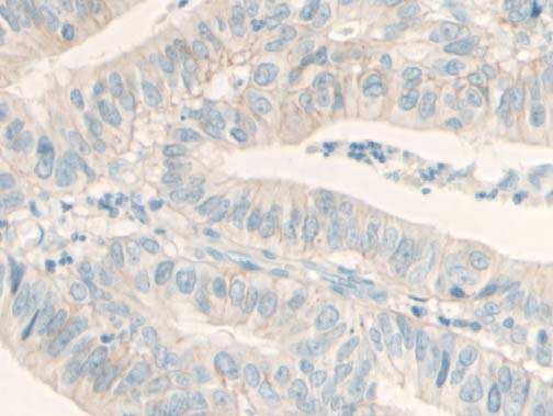 In contrast to fig 9, the same 2+ tumour section (section B on slide) in a different area A) circled in red showed B) 1+ membrane staining, with the Dako polyclonal antibody with a