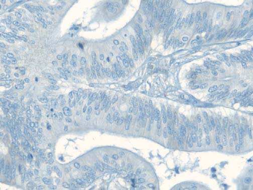 This difference in staining was only seen with the Dako polyclonal using the home-brew method. Fig 11.