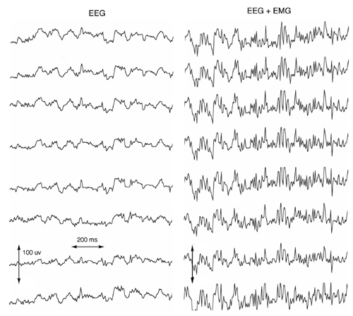 Global episodic beta/gamma synchrony 17 Freeman & Rogers Φιγ. 11. Α σαμπλε οφ 8 χονσεχυτιϖε σιγναλσ ισ σηοων φρομ α χυρϖιλινεαρ αρραψ οφ 64 ελεχτροδεσ 3 μμ απαρτ εξτενδεδ 18.