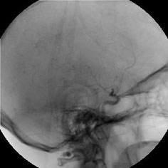 ΨΗΦΙΑΚΗ ΑΦΑΙΡΕΤΙΚΗ AΓΓΕΙΟΓΡΑΦΙΑ (Digital Subtraction Angiography DSA) Τεχνική απεικόνισης αγγείων χωρίς