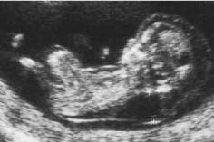 αυξημένη αυχενική διαφάνεια, η οποία παρατηρείται σε 75% των εμβρύων με χρωμοσωμικές ανωμαλίες και σε 30% των χρωμοσωμικά υγιών εμβρύων.