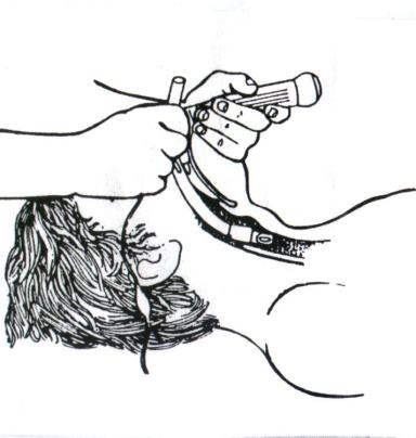 Ρεσνική: Όηαλ γίλεη νξαηή ε γισηηίδα (Πρήκαηα 4-14Β θαη 4-16Β) πξνσζείηαη ν θαηάιιεινπ κεγέζνπο ελδνηξαρεηαθφο ζσιήλαο (Πρήκα 4-16Γ) κέρξηο φηνπ