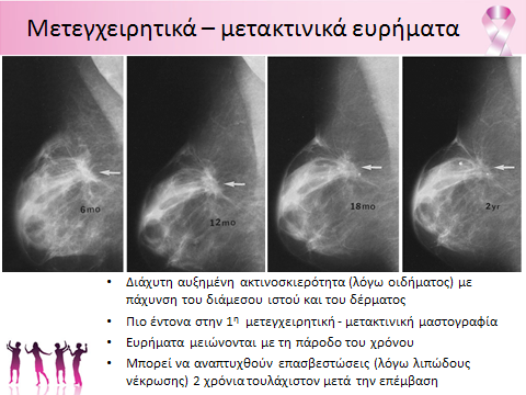 Τα μετεγχειρητικά μετακτινικά ευρήματα εμφανίζονται μαστογραφικά με τη μορφή διάχυτα αυξημένης