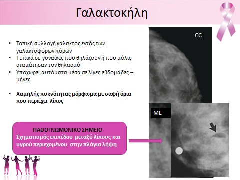 Ακτινολογικά Χρονικά, 1, 4 Παρόμοια απεικόνιση έχει και η γαλακτοκήλη, η οποία όμως στην πλάγια λήψη σχηματίζει χαρα κτηριστικό επίπεδο μεταξύ λίπους και του υπόλοι που