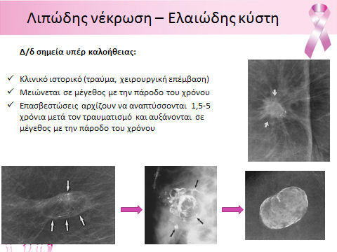 Μπορεί να έχει ασαφή εξωτερικά όρια ή ακτινωτά όρια λόγω οιδήματος, ίνωσης ή φλεγμονής. Τυπικά, εμφανίζει περιφερικές επασβεστώσεις σαν κέλυφος αυγού.