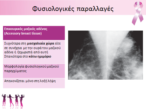 Α. Ξυνού - Καλοήθεις παθήσεις μαστού. Απεικόνιση με μαστογραφία.