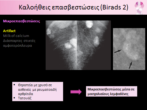 Α. Ξυνού - Καλοήθεις παθήσεις μαστού. Απεικόνιση με μαστογραφία.