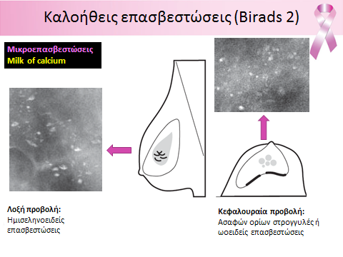 Επασβεστώσεις milk of calcium δημιουργού νται από την καθίζηση ασβεστοποιημένου λιμνά ζοντος