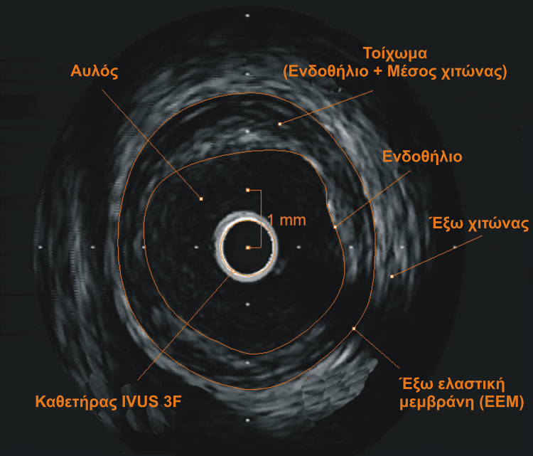 δευτερόλεπτο και εκπέμπει υπερήχους με συχνότητα 40 MHz.