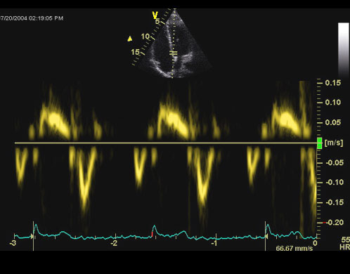 Diastolic dysfuncwon In pawents with well controlled type 2 diabetes revealed a prevalence of diastolic dysfuncwon in up to 30%.