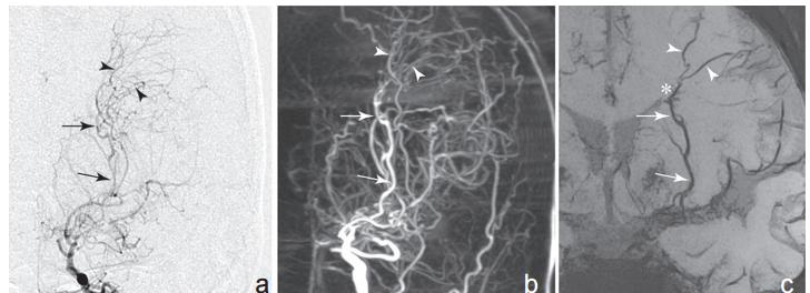 Funaki et al, Neurol Med Chir (Tokyo).