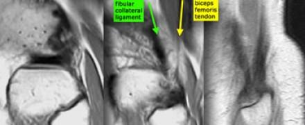 Posterolateral corner anatomy from medial to