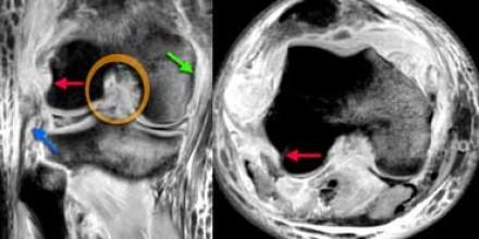 LEFT: cruciate lig.