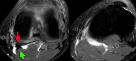 LEFT: popliteal cyst originating between semimembranosus tendon (red arrow) and gastrocnemius muscle and tendon (green arrow).