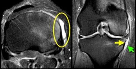 Deep infrapatellar bursitis Medial collateral ligament bursitis located