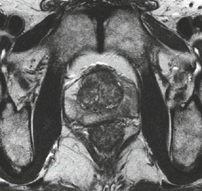 DIFFUSION-WEIGHTED IMAGING - DWI DIFFUSION-WEIGHTED IMAGING - DWI Ακολουθίες τεχνικής διάχυσης (diffusion-weighted imaging-dwi) με τις οποίες