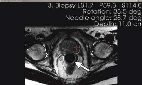 ΚΑΘΟΔΗΓΟΥΜΕΝΗ ΒΙΟΨΙΑ ΜΕ MRI ΚΑΘΟΔΗΓΟΥΜΕΝΗ ΒΙΟΨΙΑ ΜΕ MRI Eίναι μία εναλλακτική λύση στο
