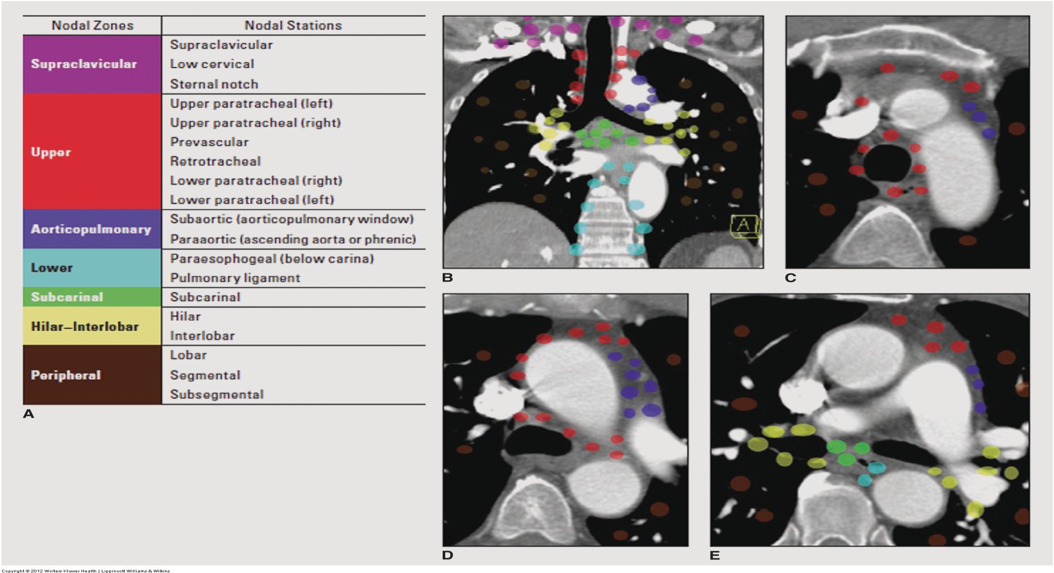 Proposed New Nodal Zones for Lung Cancer Staging.
