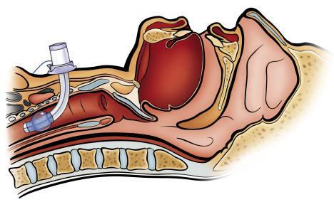 Cuffed tracheostomy tube Fenestrated