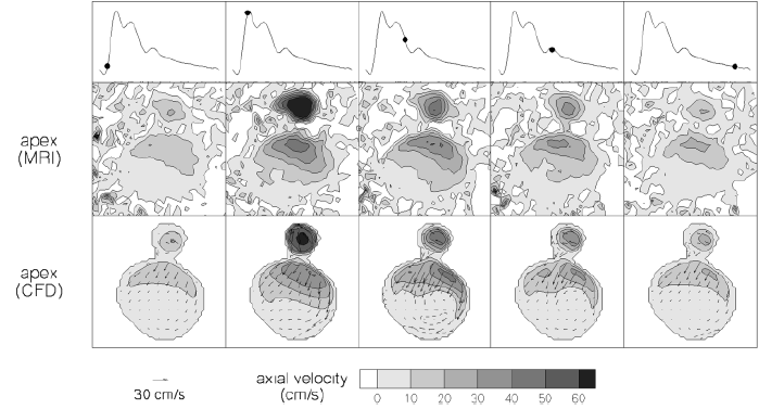 ρήκα 5.2: MRI θαη CFD απεηθνλίζεηο ησλ δεπηεξεύνπζσλ ηαρπηήησλ ζηηο επηιεγκέλεο θάζεηο ηνπ θαξδηαθνύ θύθινπ, [Steinman D.A. et al.