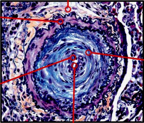 Pathobiological processes in PAH ADVENTITIA Inflammatory cells & fibrosis Cyto/chemokines, matrix metalloproteases, tenascin & B-FGF MEDIA Smooth muscle cell hyperplasia Membrane potassium channel