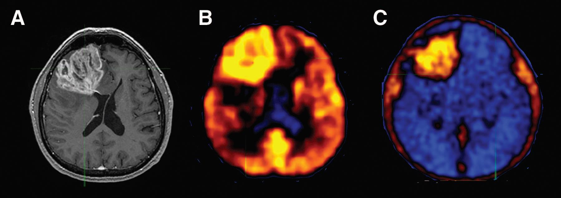 ΓΛΟΙΟΒΛΑΣΤΩΜΑ: Α. MRI B.