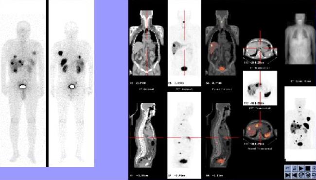 ΑΛΛΑ Ρ/Φ ΡΕΤ 68Ga-DOTATOC PET/CT: υποδοχείς σωματοστατίνης