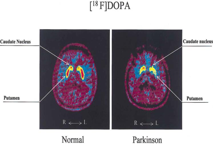 ασυμφωνία MRI-EEG Μελέτη παθοφυσιολογίας της νόσου (επίδραση της νόσου στην αιματική ροή & μεταβολισμό γλυκόζης του εγκεφάλου) Προεγχειρητική εκτίμηση του παρακείμενου της