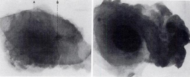 Albert Salomon, Γερμανός χειρουργός, 1913 Ακτινογράφησε 3000 μαστούς από