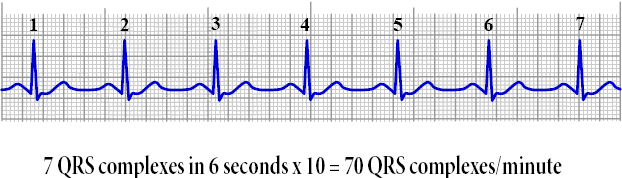 φωνοκαρδιογράφηµα. Το φωνοκαρδιογράφηµα είναι µια καταγραφή ήχων που παράγονται κυρίως απο την καρδιά δια µέσου των καρδιακών βαλβίδων.