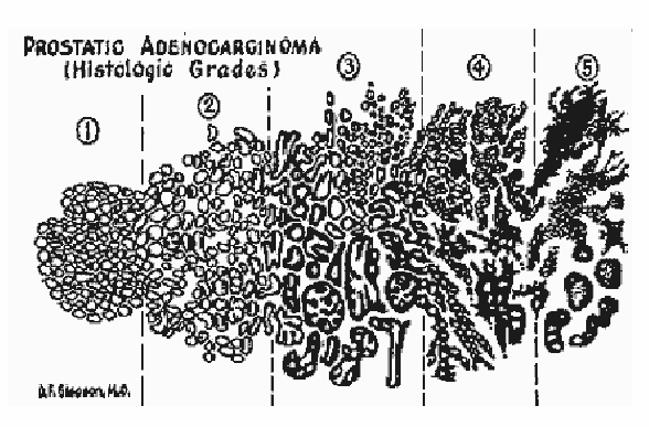 γία θαηά Gleason score ππνινγίδεηαη κε βάζε ηε κνξθνινγία θαη ηελ αξρηηεθηνληθή δηάηαμε ησλ αδελίσλ ηνπ πξνζηάηε.