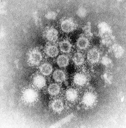 Immune aggregate of hepatitis A virus following the addition of convalescent serum to a fecal extract during the acute phase of the