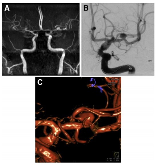 Σχήμα 4.4: A. Απεικόνιση ανευρύσματος μέσης εγκεφαλικής αρτηρίας με Μαγνητική Αγγειογραφία Β. Απεικόνιση του ίδιου ανευρύσματος με Ψηφιακή Αγγειογραφία C.