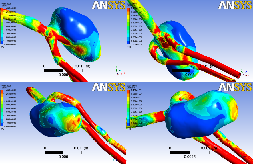 Σχήμα 5.17: Απεικόνιση της κατανομής της WSS στη γεωμετρία υπό 4 διαφορετικές γωνίες. ζουν σημαντικό ρόλο στην ανάπτυξη του ανευρύσματος και αποτελούν παραμέτρους μελέτης όλων των δημοσιεύσεων.