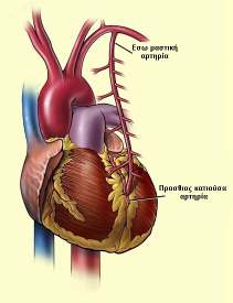 Εικόνα 9 : Αορτοστεφανιαία παράκαµψη µε χρήση της έσω µαστικής αρτηρίας Εικόνα 10 : Το δίκτυο των στεφανιαίων αρτηριών Έχει παρατηρηθεί πως η