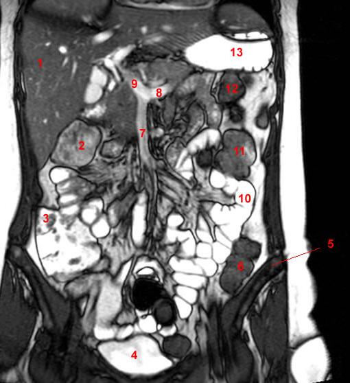 1, ήπαρ 2, ηπατική καμπή 4, ουριδόχος κύστη 5, λαγόνιο οστό 6, σιγμοειδές 7, άνω μεσεντλεριος φλέβα
