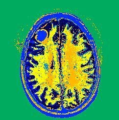 enhanced MRI Image Fusion (256 levels)